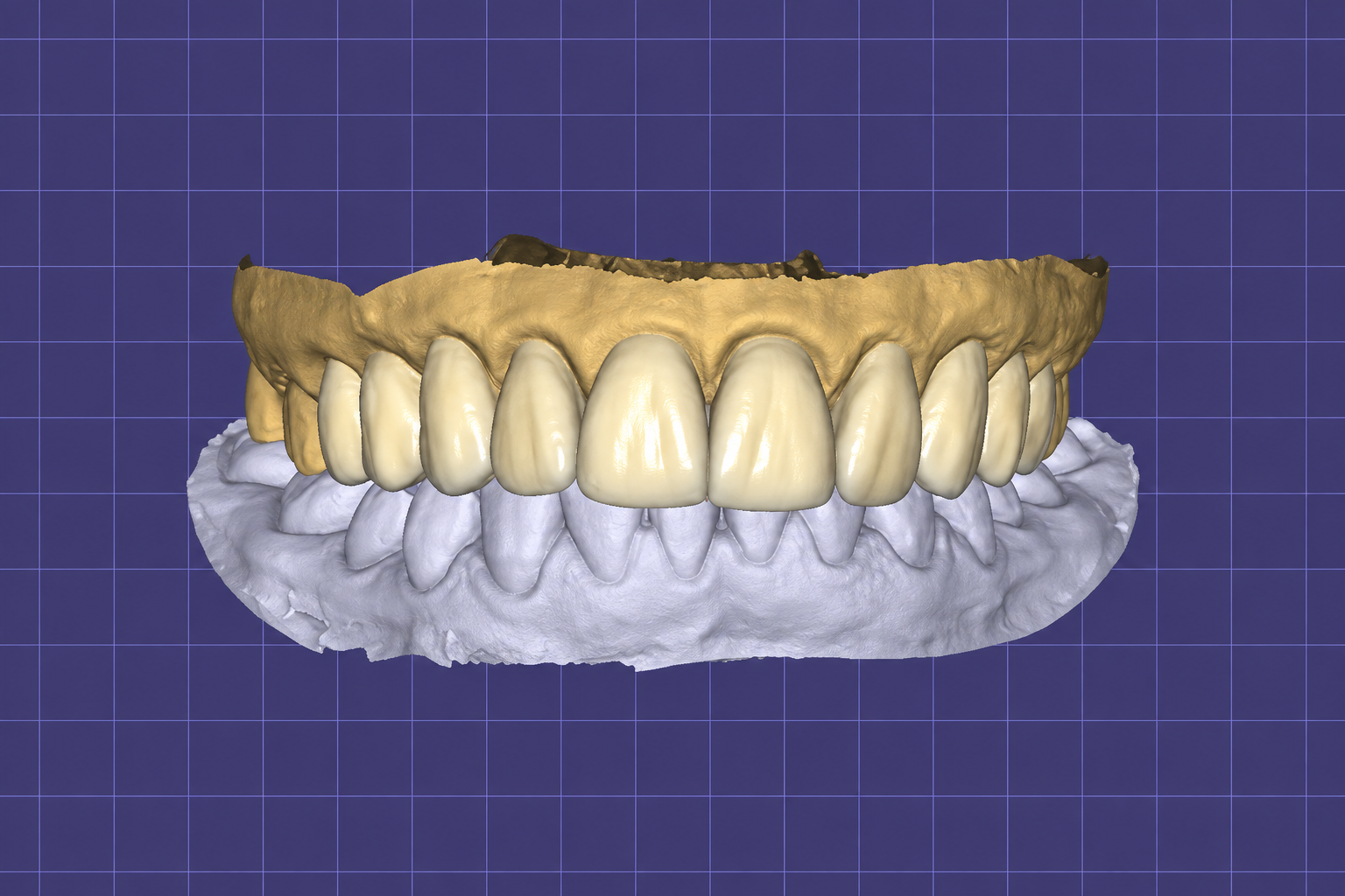 Diseño digital de una restauración dental