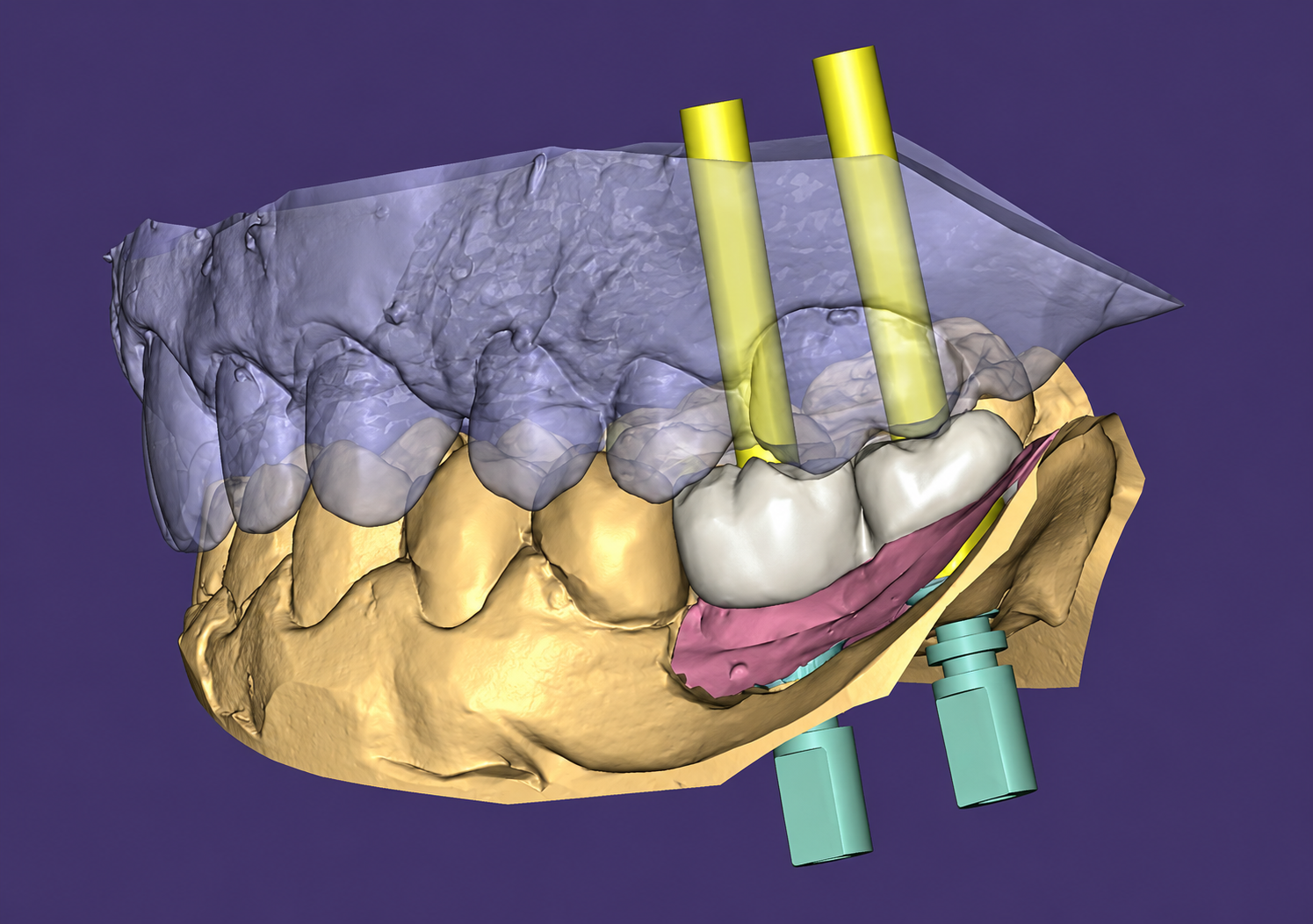 Planificación tridimensional de implantes dentales
