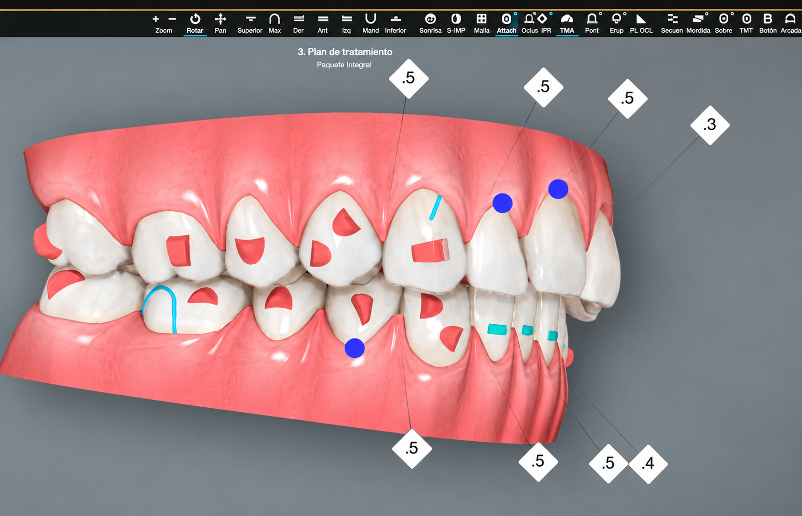 Simulación de movimientos dentales con ClinCheck
